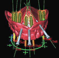 27 Implante diagrama3d