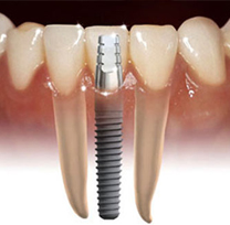 27 Implante en dientes